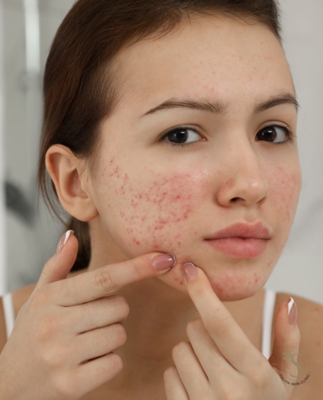 Acne scar treatment in islamabad