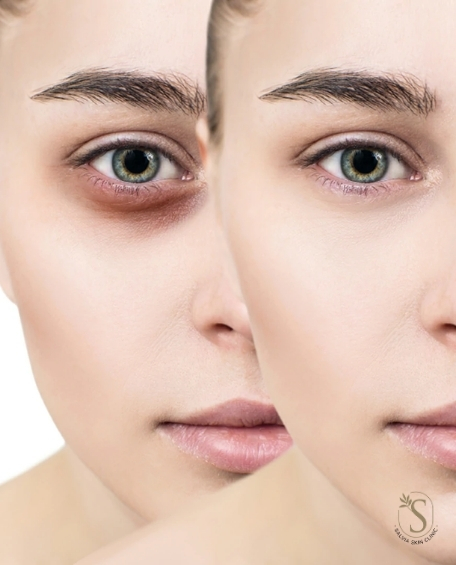 Dark Circles Treatment in Islamabad