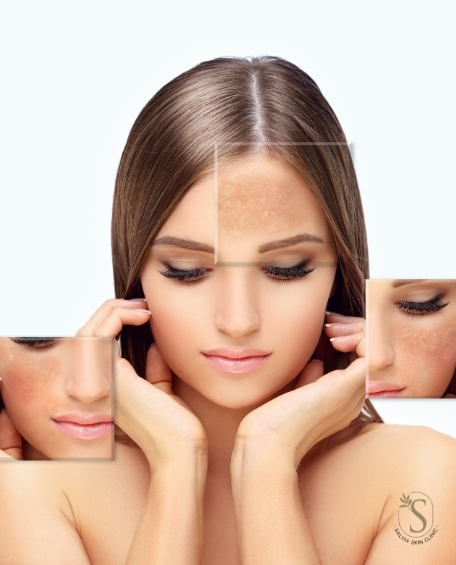 Pigmentation Treatment in Islamabad